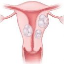treatment-uterine-fibroids