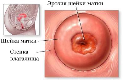 Gebärmutterhalskrebs Erosion