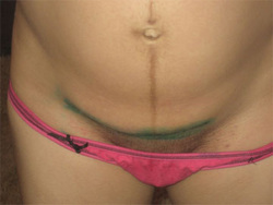 Seam after the operation of the cesarean section