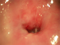 Cervix, utsikt från vagina