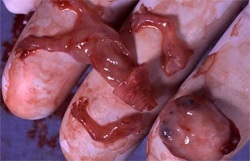Abtreibung eines 8 Wochen alten Fötus