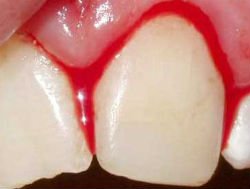 bleeding-gums