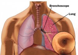 Bronchi, bronchoscopie, diagnose, longen