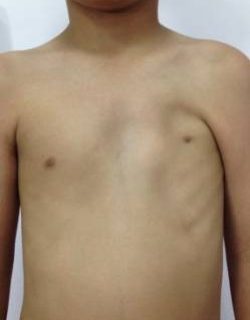 chest-deformity