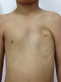 chest, thoracic deformation, bones, lungs