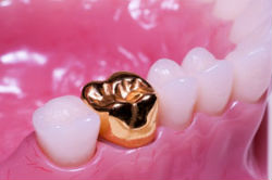 Crowns in dentistry, what better to put