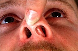 curvatura de la partición, nariz, seccional nasal, fracturas