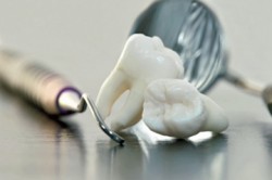 dentes, dente retentado, odontologia, remoção de dentes, cuidados com os dentes