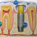 implantation-tooth