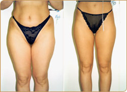 Före (vänster) och efter (höger) fettsugning