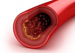statina-decrease-cholesterol