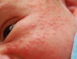 Reação alérgica, alergia, alergia em uma criança, mama crianças, imunologia, recém-nascido
