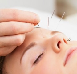 Acupuncture, acupuncture, alternative medicine, therapy