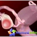 Functional ovarian cysts cyst