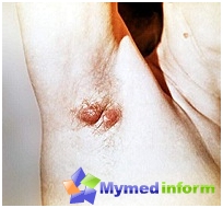 What is hydradenitis