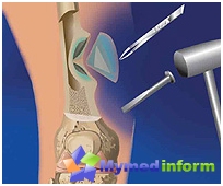 osteomyelitis what to do and how to treat