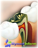 Osteomielite Jaws, sintomas e tratamento