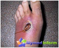 Diagnose og behandling af gas gangrene