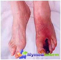 Gas Gangrene, symptomen, behandeling