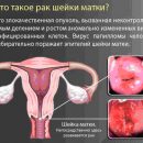 how to protect yourself from cervical cancer