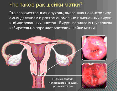 Cómo protegerse del cáncer cervical