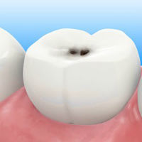 Deep Caries: Symptoms, Characteristics and Causes