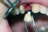 أطقم الأسنان غير القابلة للإزالة