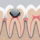 etiology and pathogenesis of dental caries key to understanding