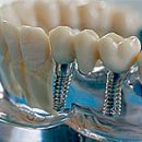 whether it is possible in your case, dental implants