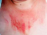 Hvordan fjerne huden betennelse & ndash; salver og kremer med hormoner og uten