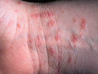 scabies modern view of the disease