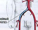 aortic femoral bypass