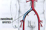 aortic femoral bypass