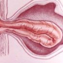 hernia in questions and answers