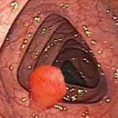 colon polyps causes and symptoms