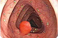 Полип на дебелото черво: причини и симптоми на заболяването