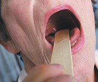 Tonsillite chronique - une maladie qui détruit l'organisme entier