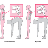 the main symptoms and treatment options kyphosis