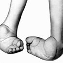 if the child has clubfoot