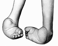 if the child has clubfoot
