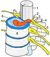 La hernie du cartilage intervertébral - qu'est-ce que c'est?