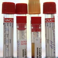 Test som används för att diagnostisera medfödd immunbrist
