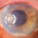 corneal ulcer causes symptoms treatments
