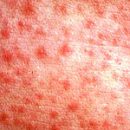 It looks like a rash of scarlet fever at home diagnostics