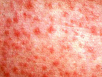 What a rash looks like a scarletine & ndash; Diagnosis at home