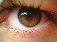 asthenopia eye fatigue syndrome