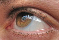 Синдром умора за очи (астенопија)