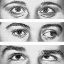 types of strabismus
