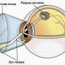 laser coagulation in the treatment of retinal detachment