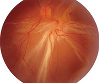 diagnosis of retinal detachment
